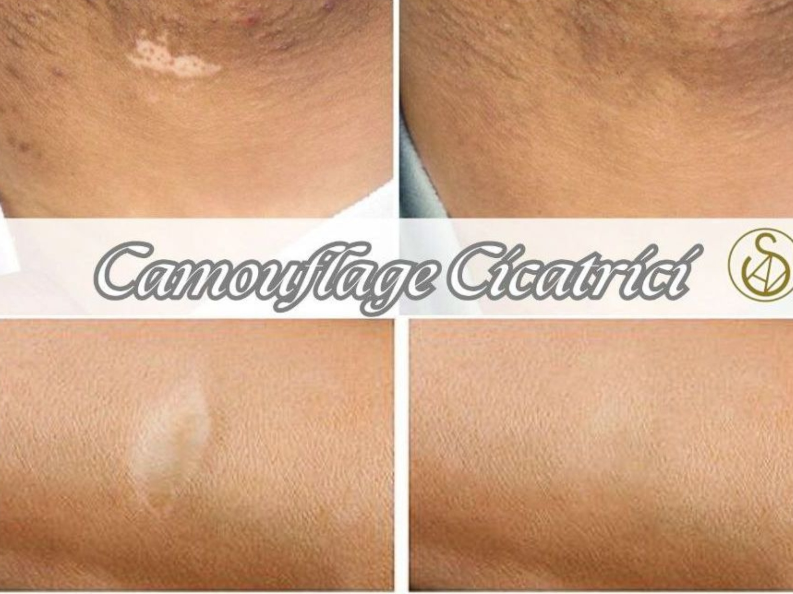 Trattamento delle CICATRICI