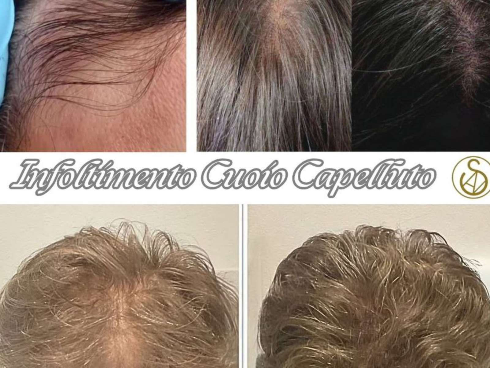 Infoltimento CUOIO CAPELLUTO