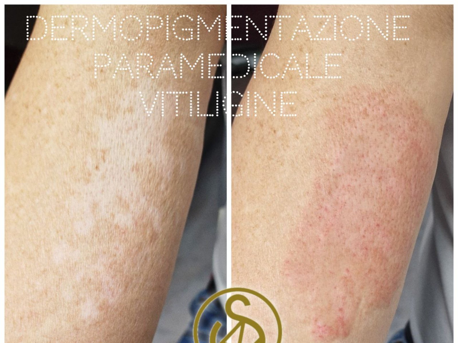 Pigmentazione delle macchie di VITILIGINE